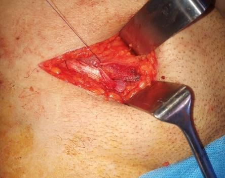 Modified-Lichtenstein-mesh repair